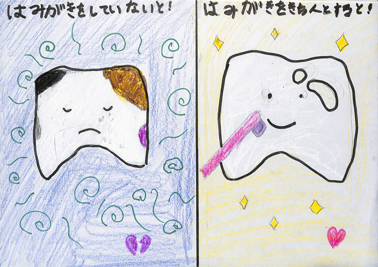C217 虫歯にならないために つむ